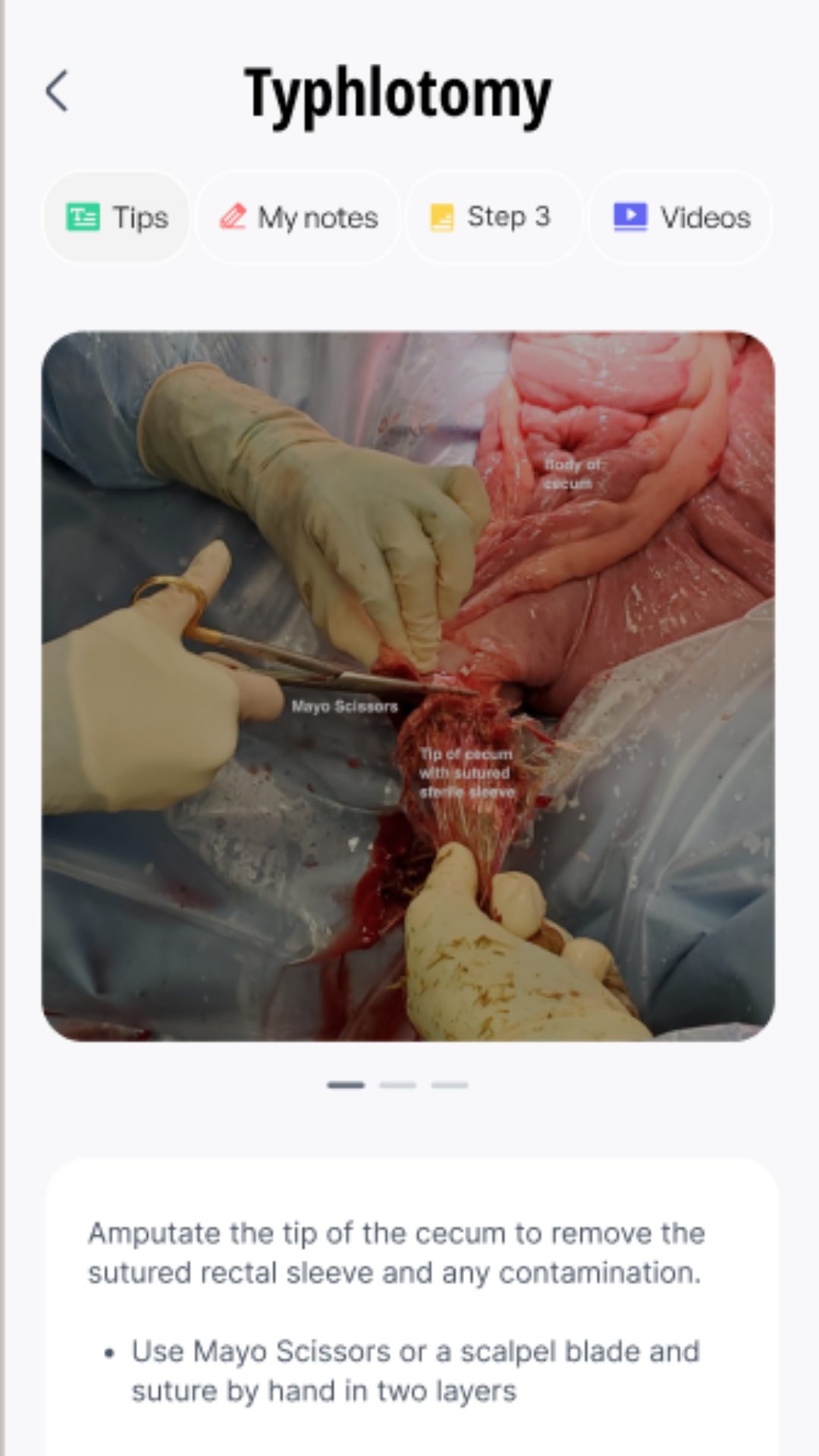 SurgeMate Pro app surgical step screenshot